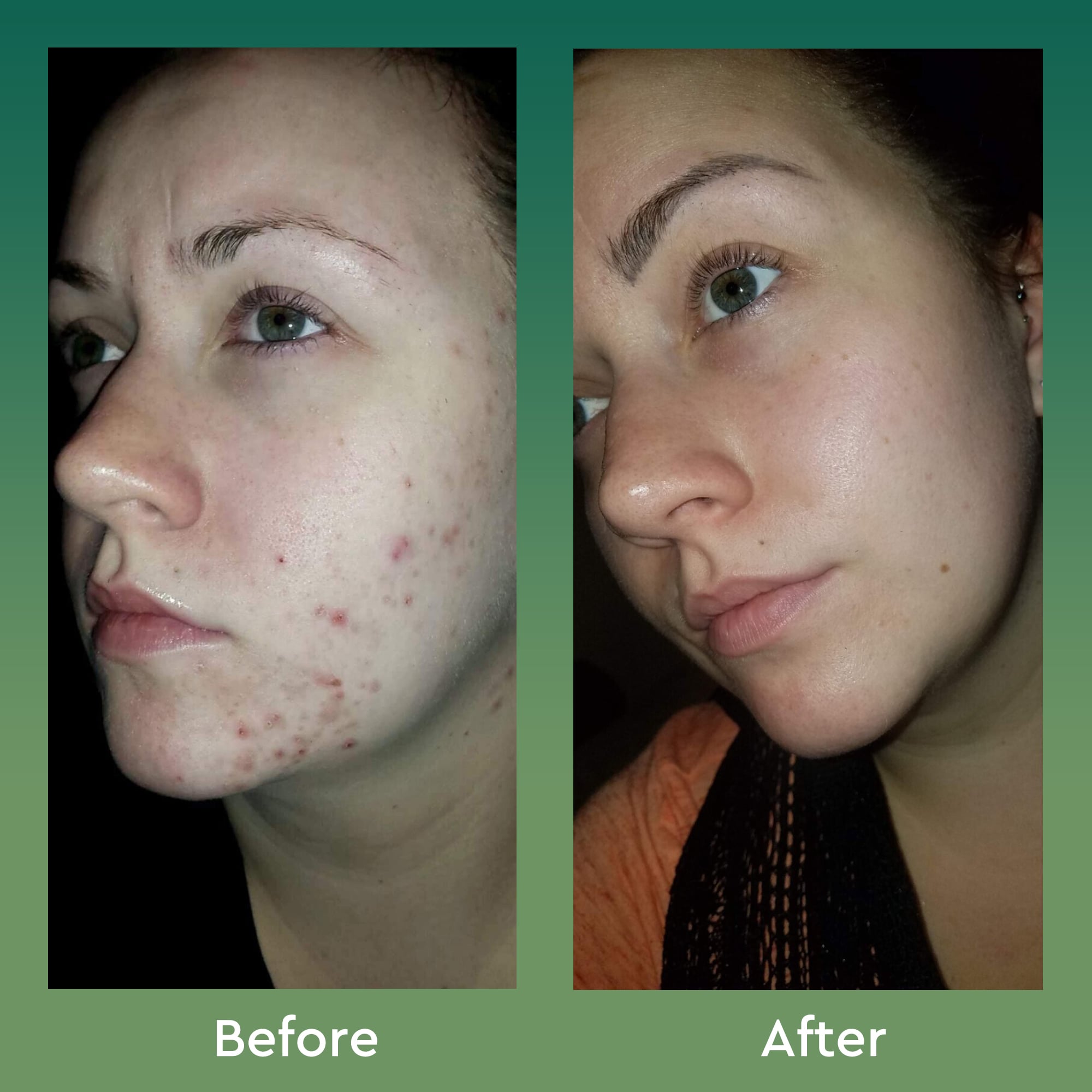 bioClarity Clear Skin Routine Before and After photo