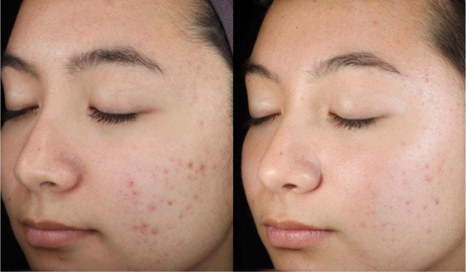 Clear Skin Routine PlantBased Acne Treatment Set bioClarity